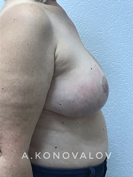 Пациент 3 "Подтяжка груди" - фото 2